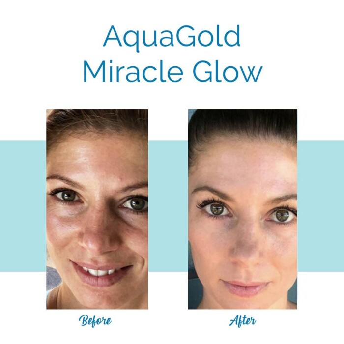Aquagold Miracle Glow - Before & After