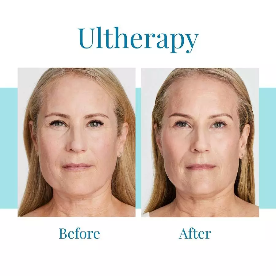 Bella Medspa is the best Buckhead and Alpharetta provider of Ultherapy