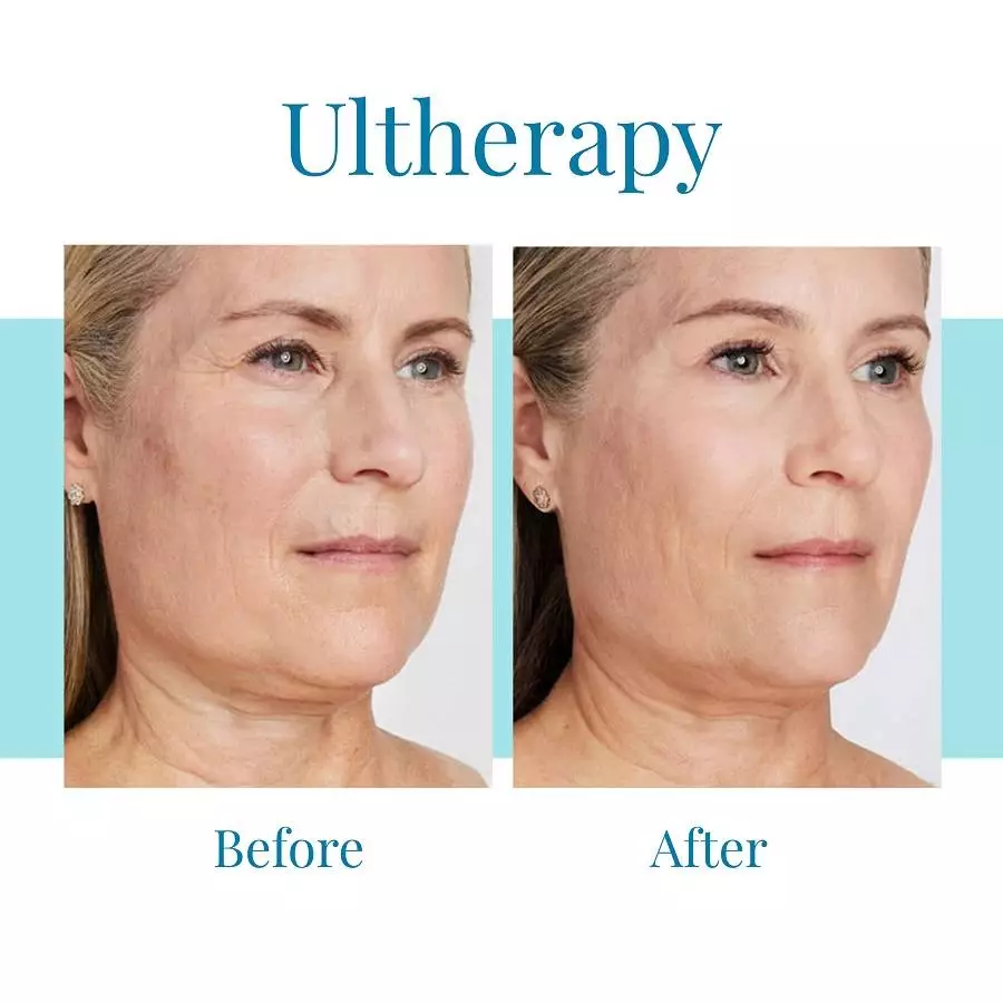 Bella Medspa is the best provider of Ultherapy in Buckhead and Alpharetta