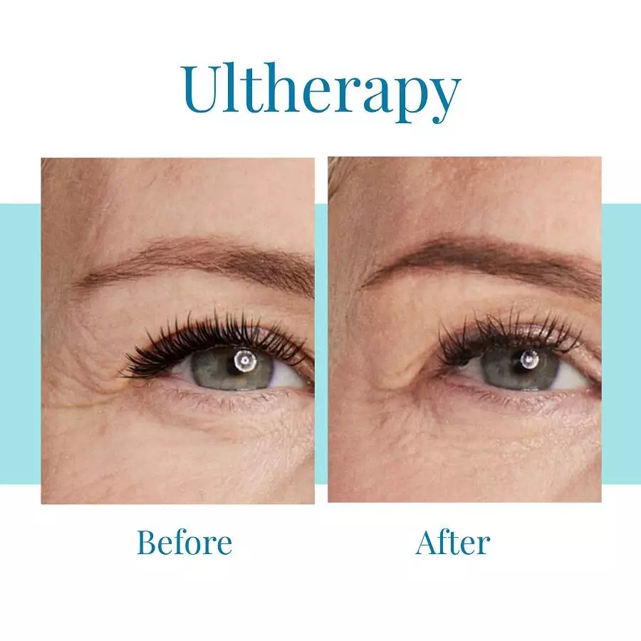 Bella Medspa is the top Buckhead and Alpharetta provider of Ultherapy