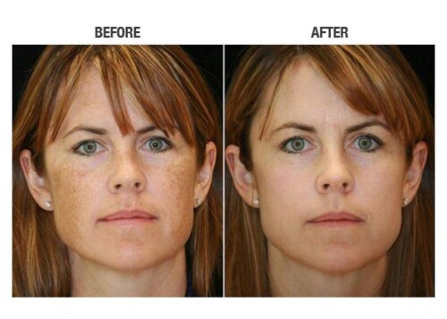 IPL FACIAL - Before and After