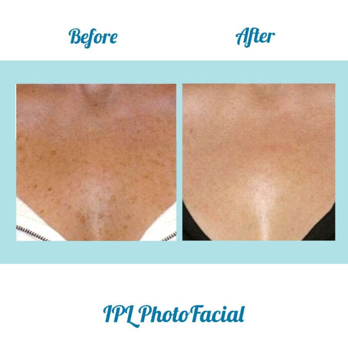 IPL Photofacial