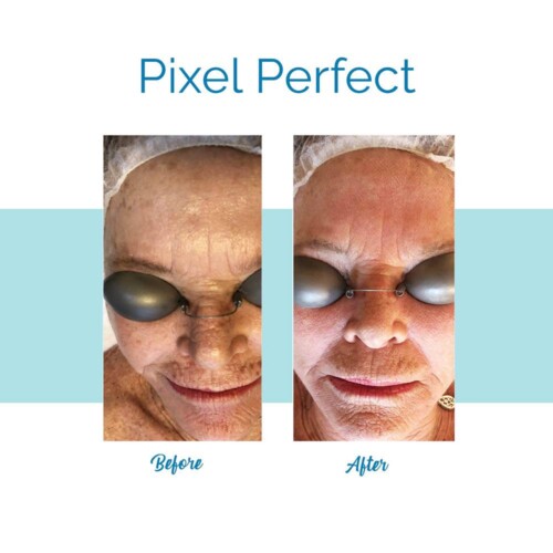 Pixel Perfect Laser Facial - Before & After