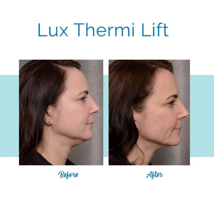 Thermi Lift - Neck