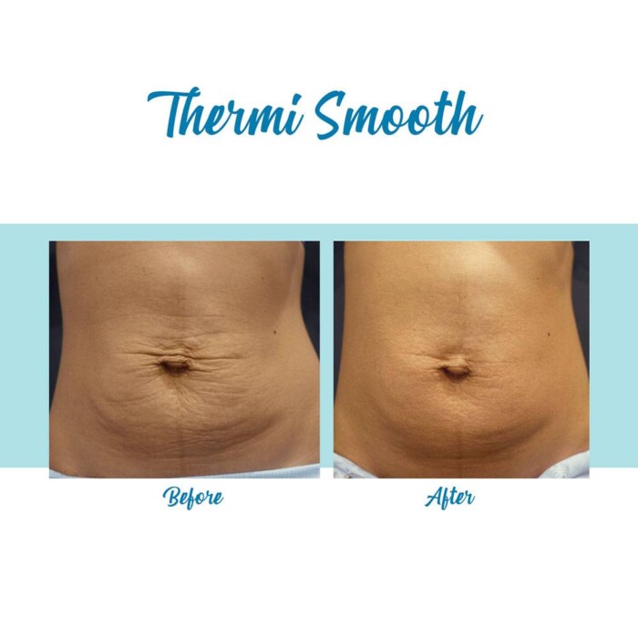 Bella Medspa in Buckhead and Alpharetta offers ThermiSmooth body contouring and skin tightening treatments