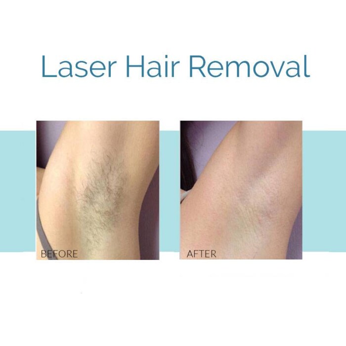 Laser Hair Removal