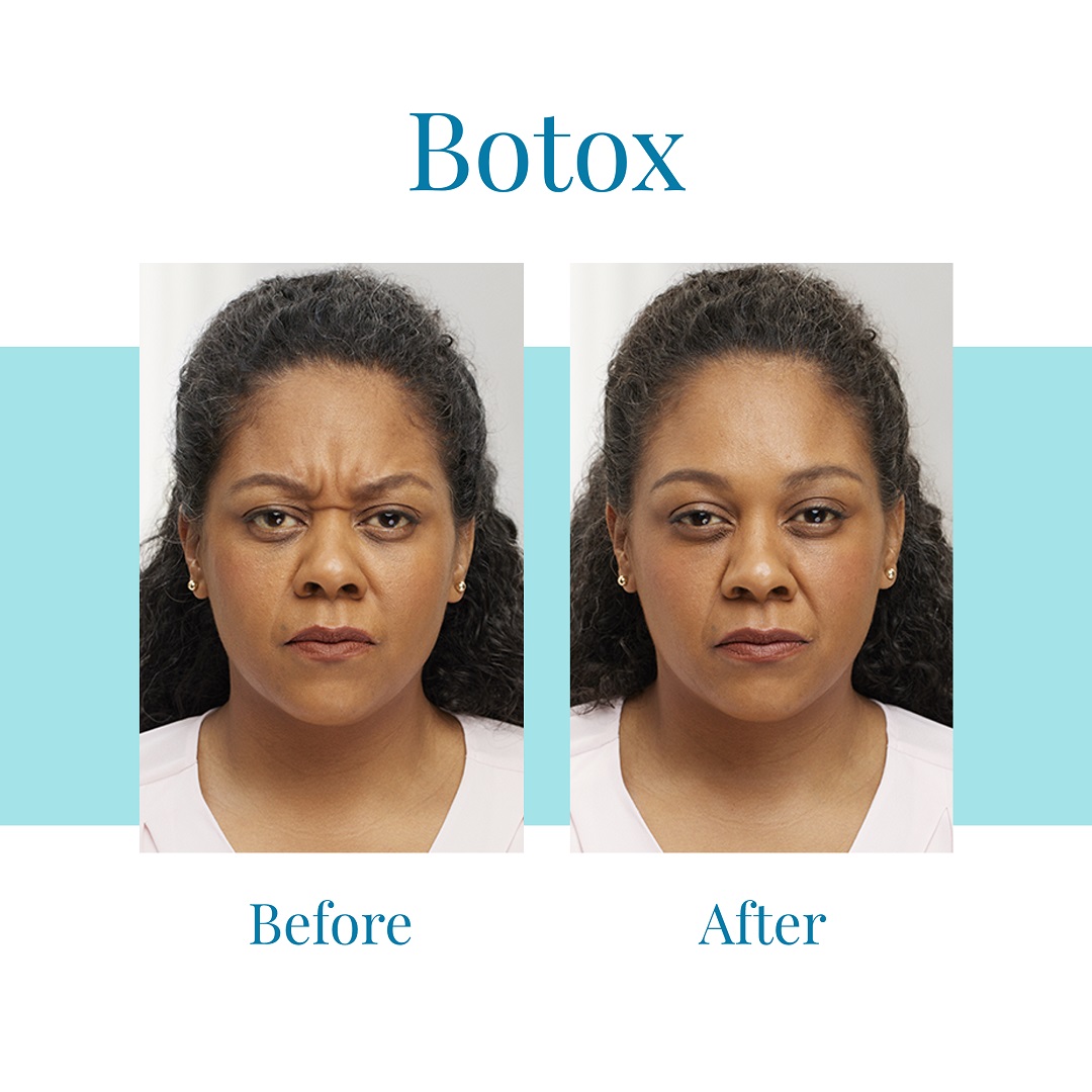 Bella Medspa is the top provider of Botox in Alpharetta