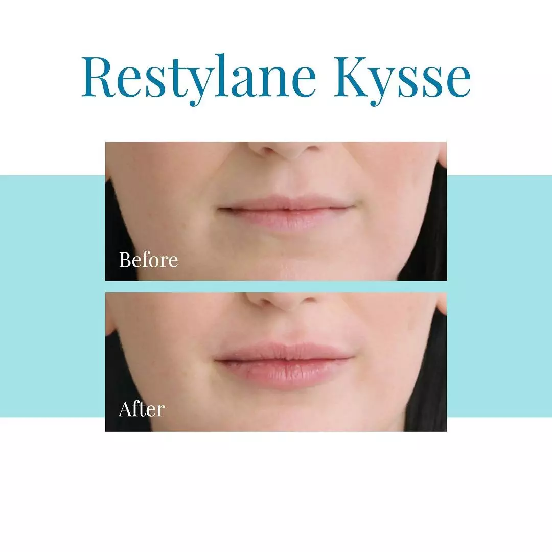Bella-Medspa-is-the-top-provider-of-Restylane-Kysse-injections-in-Alpharetta