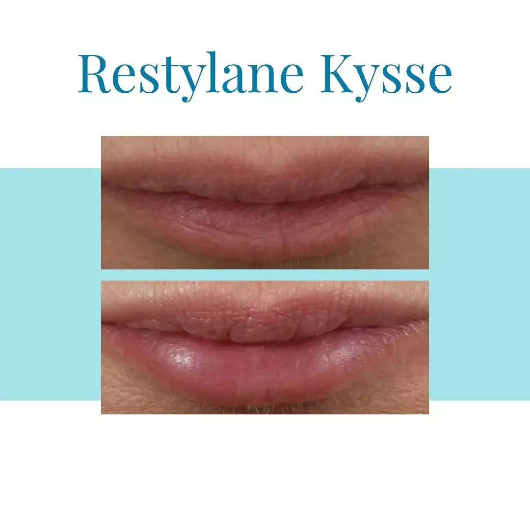Bella-Medspa-is-the-top-provider-of-Restylane-Kysse-injections-in-Buckhead