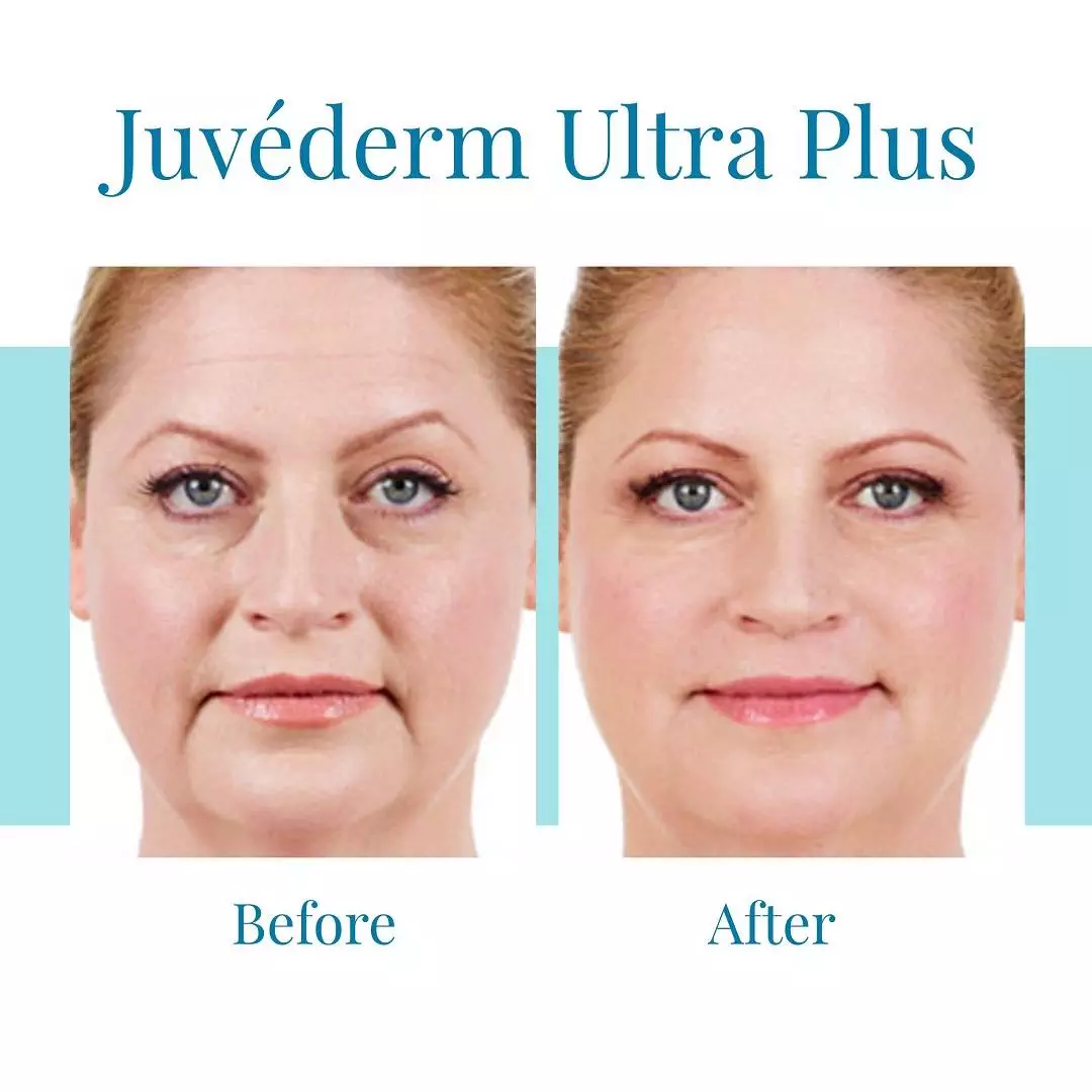 Bella-Medspa-offers-Juvederm-Ultra-Plus-injections-in-Buckhead