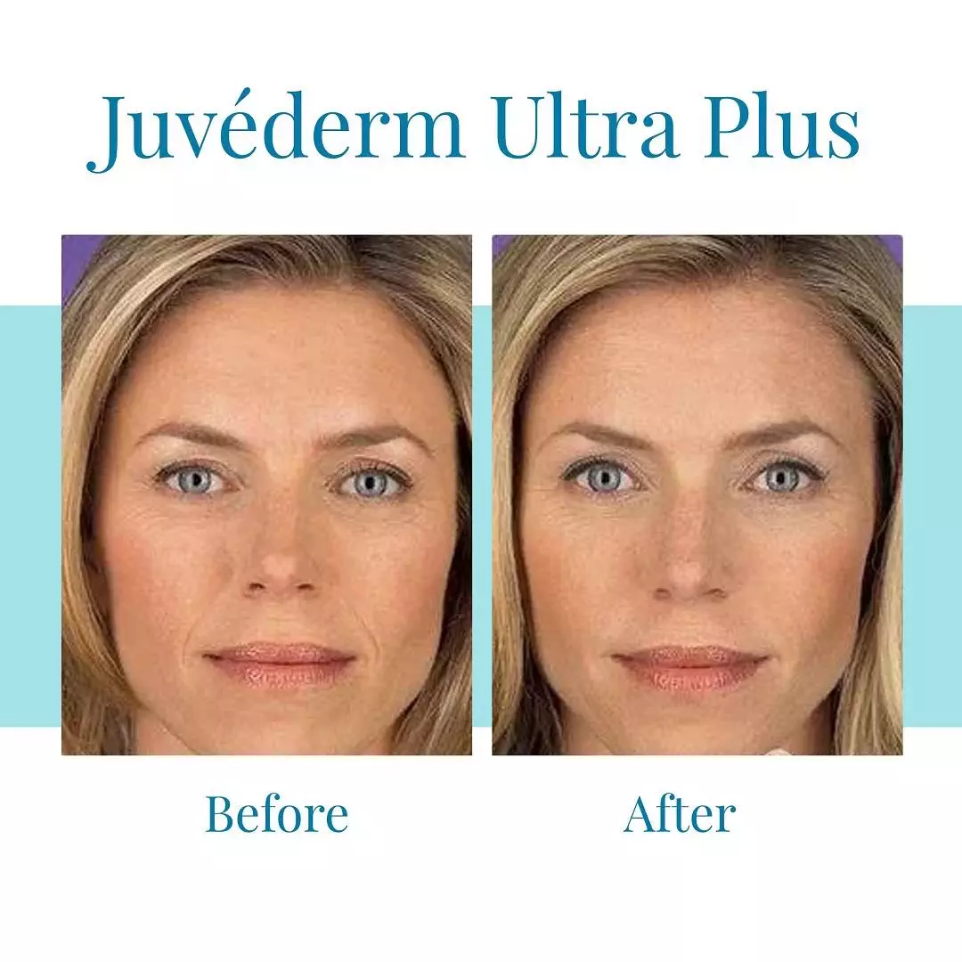Bella-Medspa-offers-Juvederm-Ultra-Plus-treatments-in-Buckhead