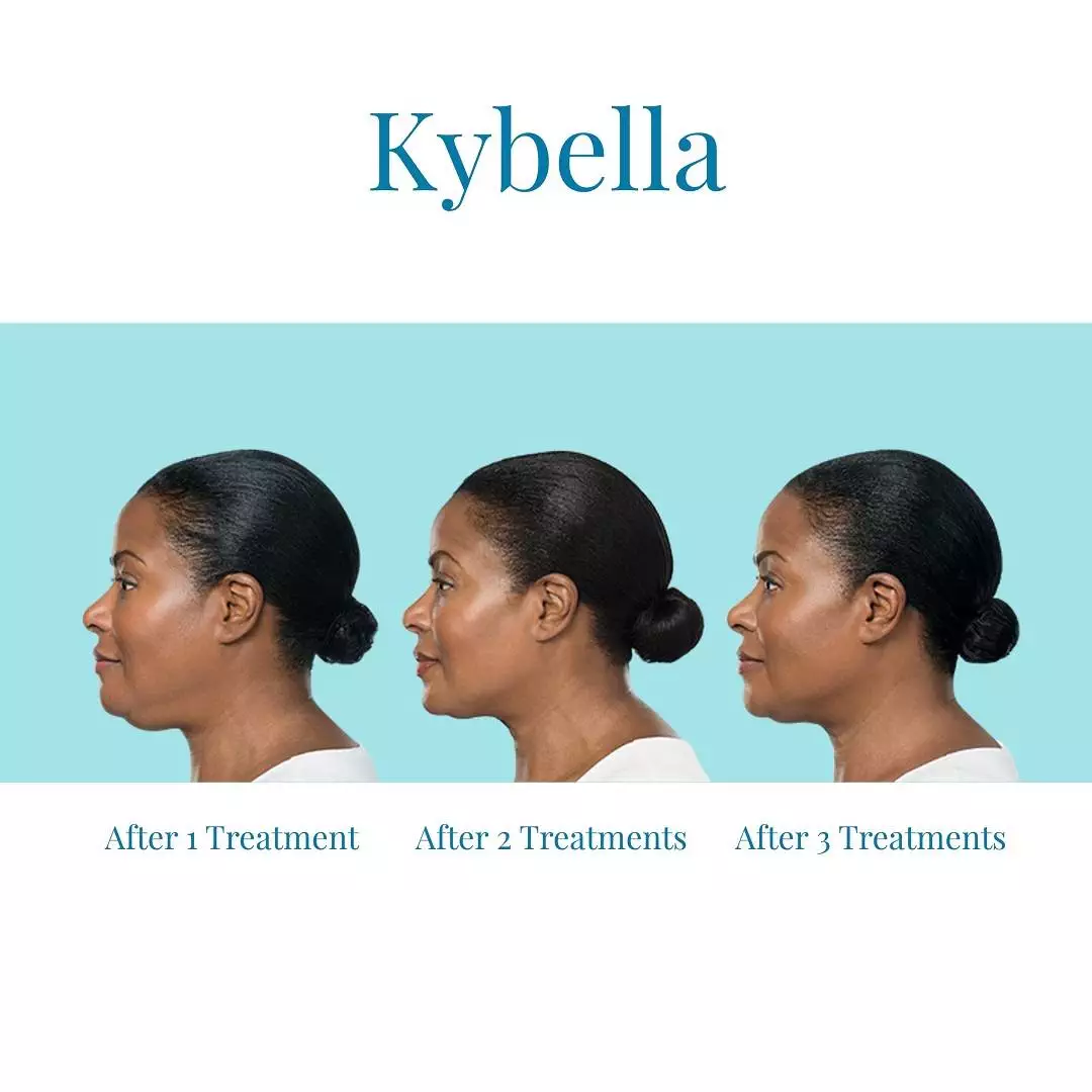 Bella-Medspa-offers-Kybella-injections-in-Buckhead