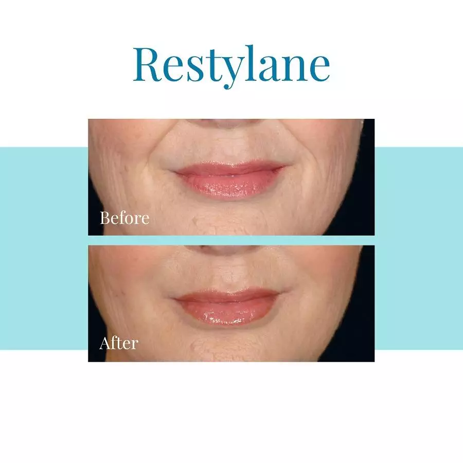 Bella-Medspa-offers-Restylane-injections-in-Buckhead