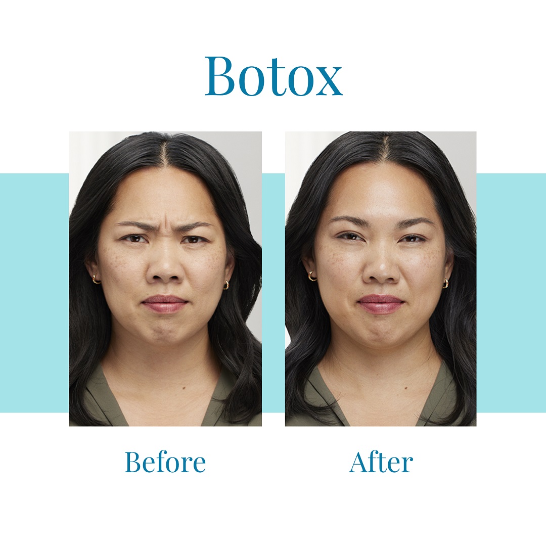 For Botox injections in Alpharetta or Buckhead, trust Bella Medspa