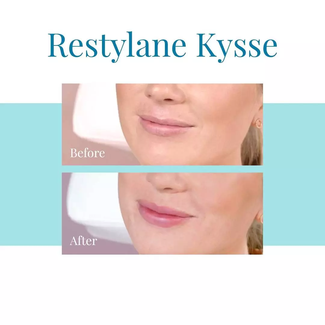 For-Restylane-Kysse-injections-in-Alpharetta-trust-Bella-Medspa