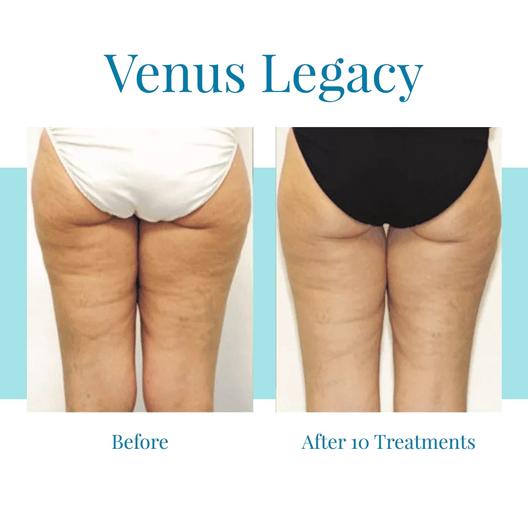 For the best Venus Legacy results in Buckhead, turn to Bella Medspa